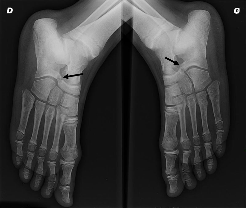 imagerie_pathologie_arriere_pied coalition tarsienne